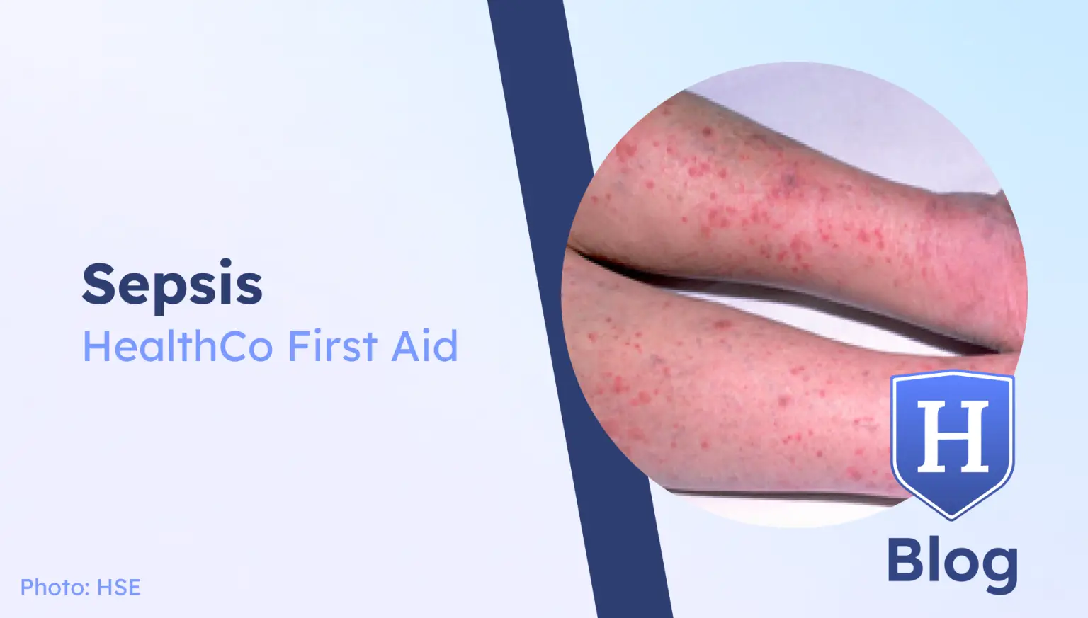 Legs with a visible rash, illustrating a potential symptom of sepsis, alongside 'Sepsis HealthCo First Aid' branding.